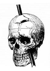 Phineas Gage Kafatası ve Tamping Demiri (1868)